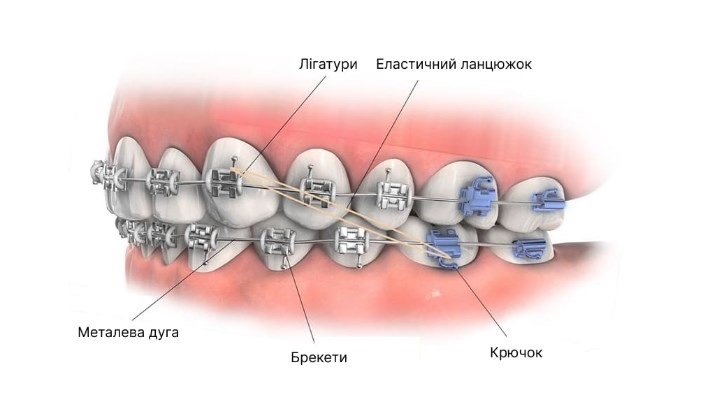 брекети у Львові.